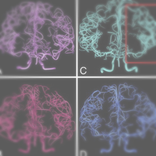 Digital reconstruction and morphometric analysis of human brain arterial vasculature from magnetic resonance angiography.