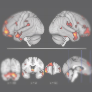 Relationships between gray matter, body mass index, and waist circumference in healthy adults.